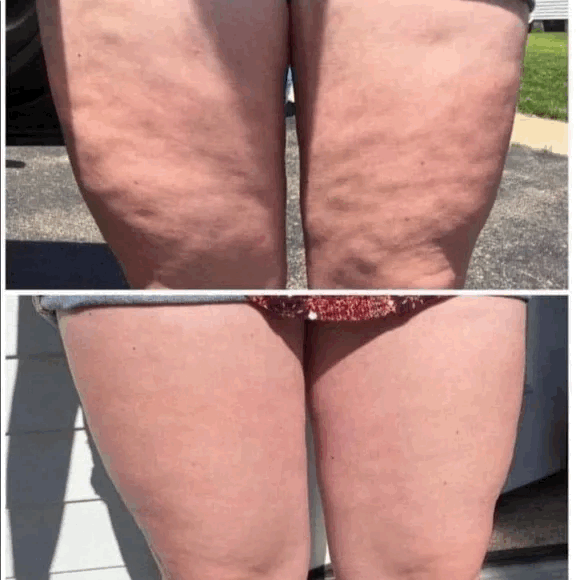Anti Cellulite Massager