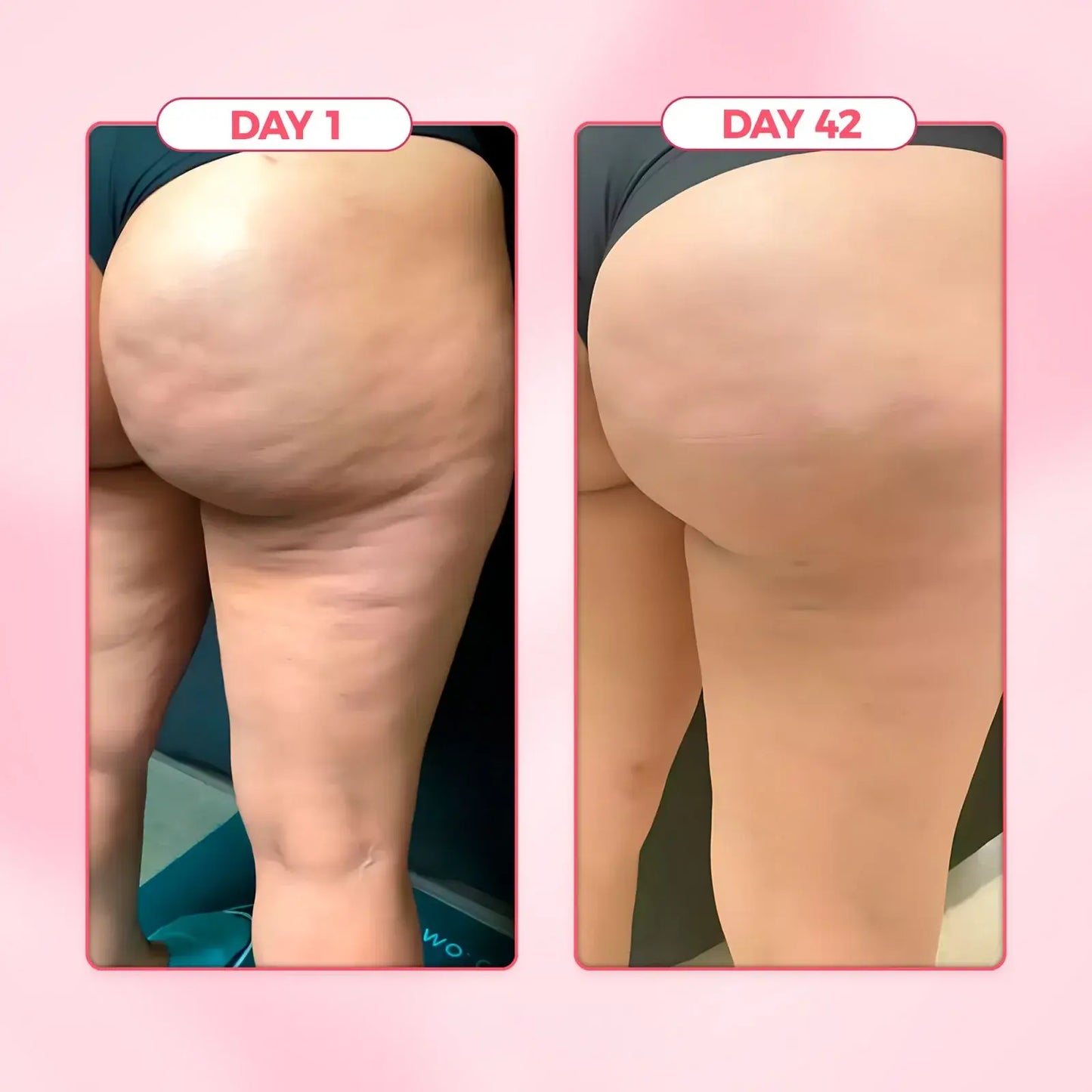 Anti Cellulite Massager